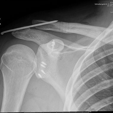 Minimal-invasive AC-Gelenksstabilisierung & arthroskopische Labrumrefixation bei einem Handball-Nationalspieler